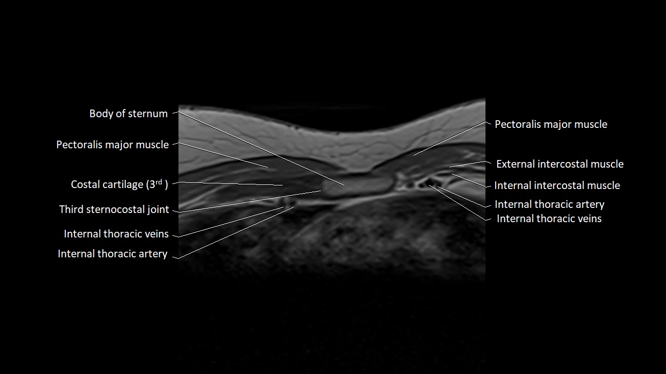 MRI sternum and sternoclavicular joint labeled axial anatomy image 20.webp